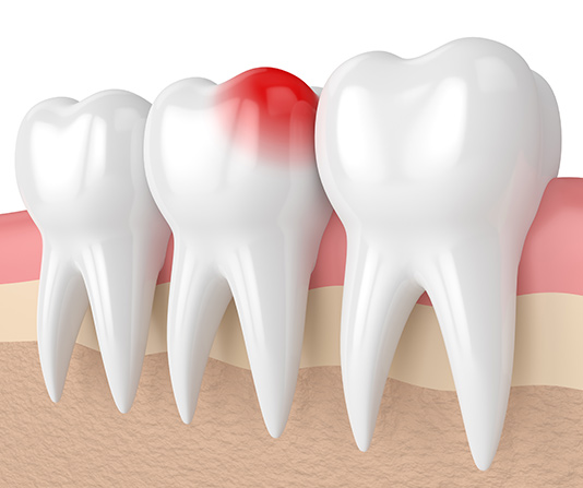 3D model of teeth sandwiching a painful tooth