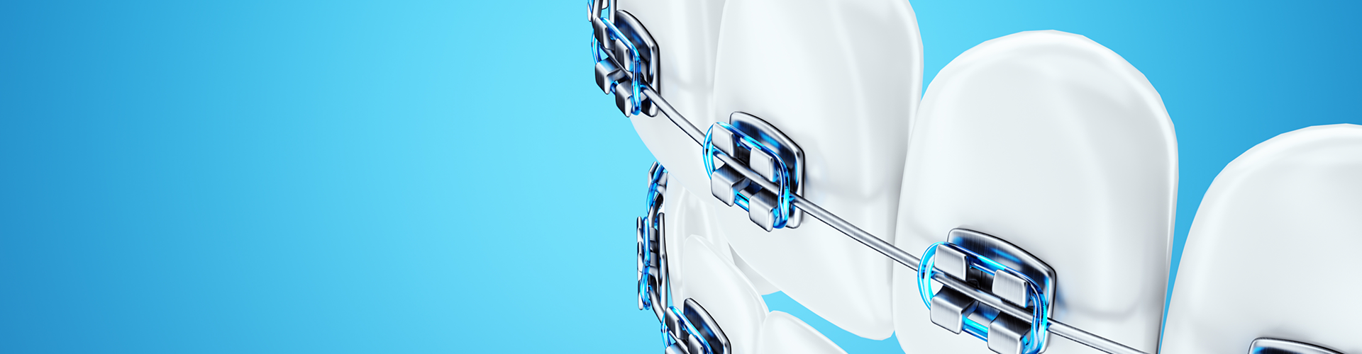 rendering of teeth with dental braces