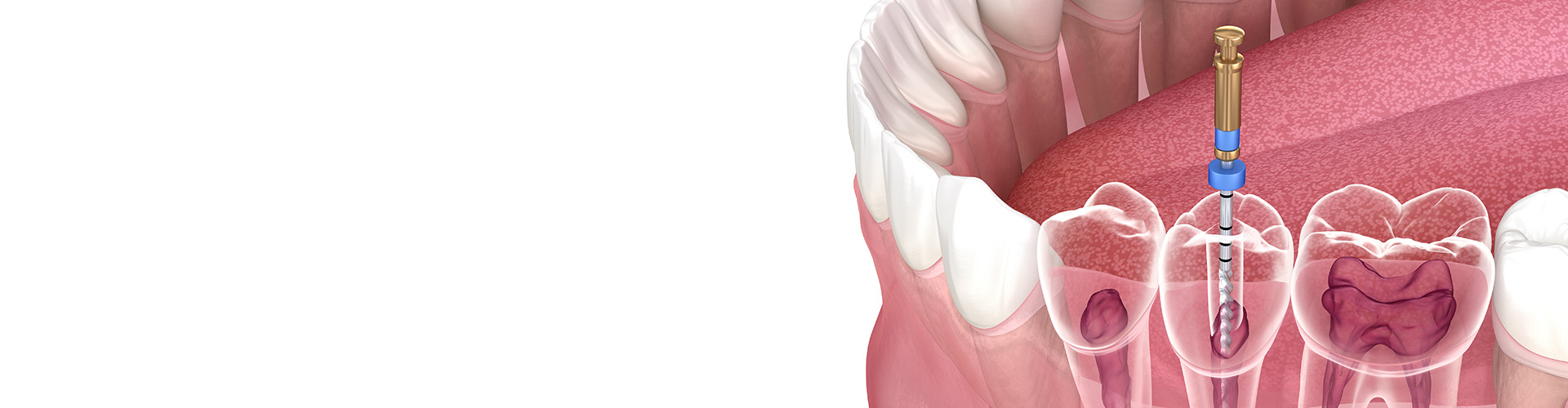 rendering of lower teeth having root canal treatment