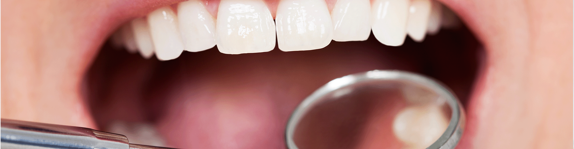 dental mirror in mouth reflecting biting surface of teeth