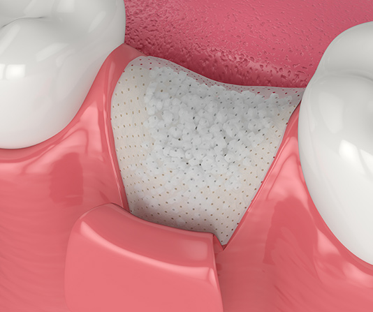 Bone grafting illustration