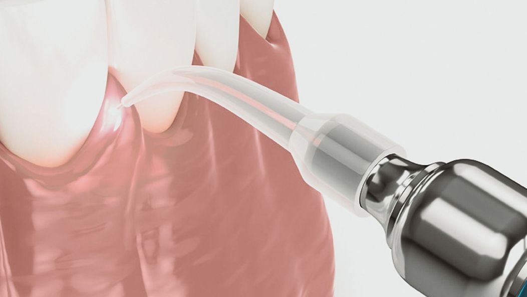 An image of teeth being cleaned