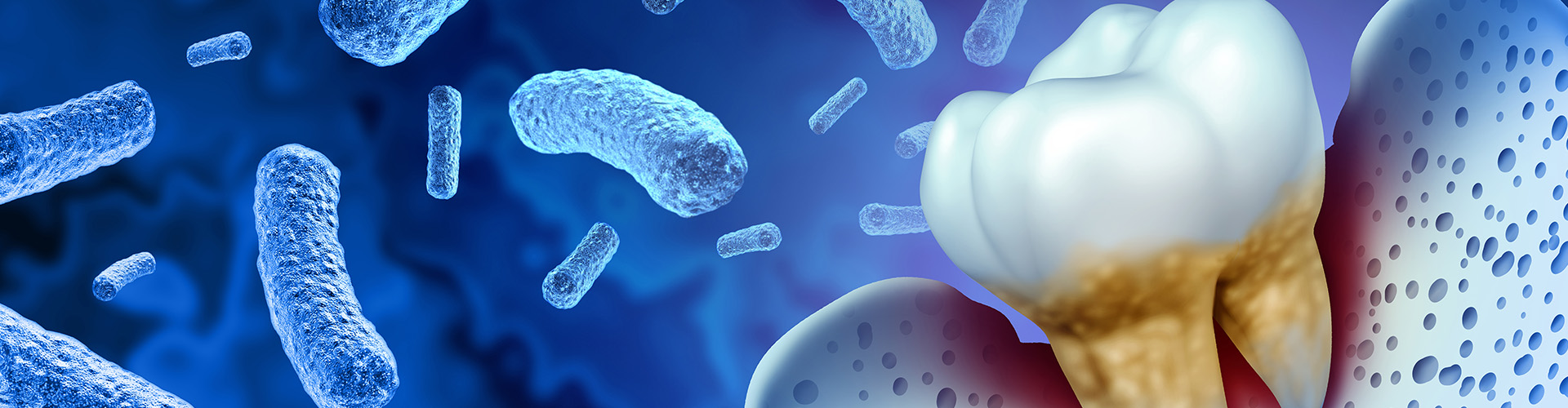 rendering of a tooth with tartar buildup around it's root