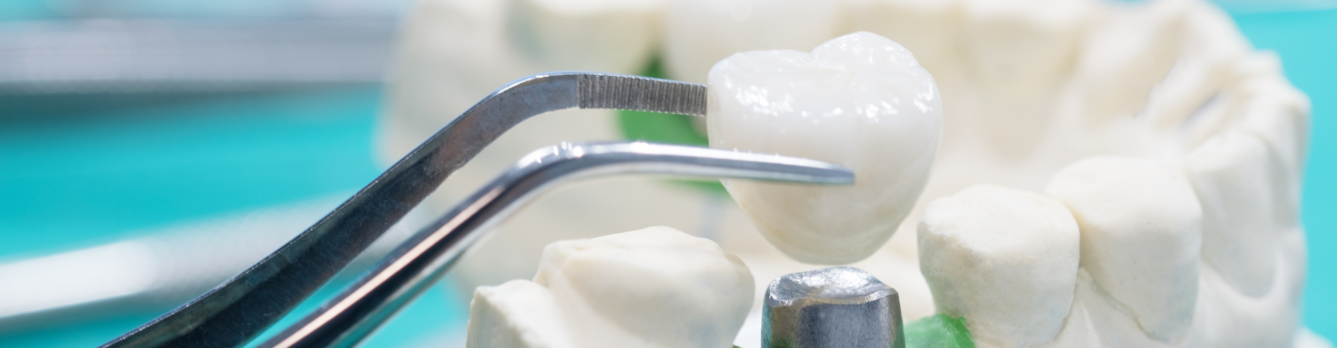 porcelain crown being placed in an abutment in a mandible model