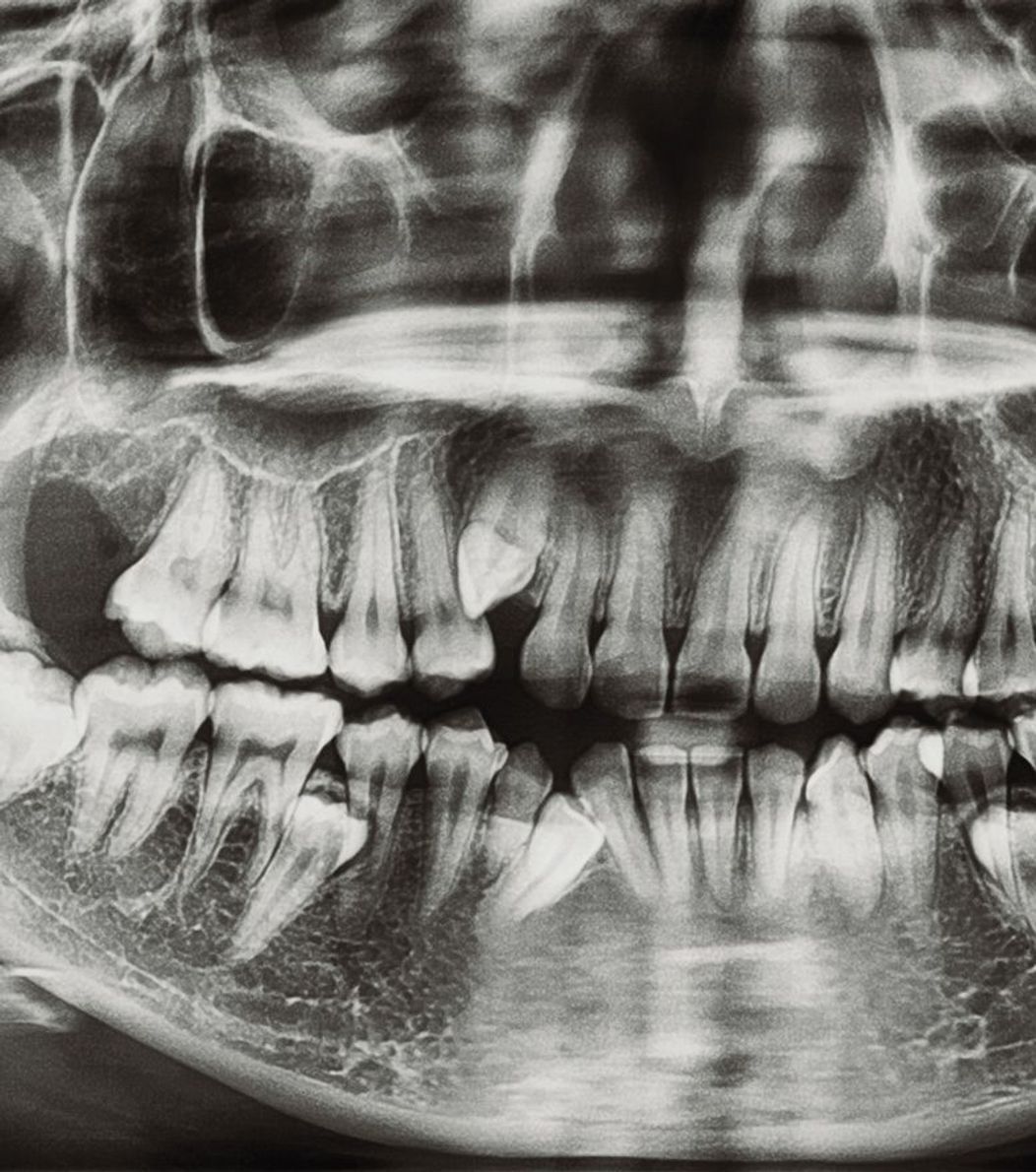 X-ray of impacted wisdom teeth