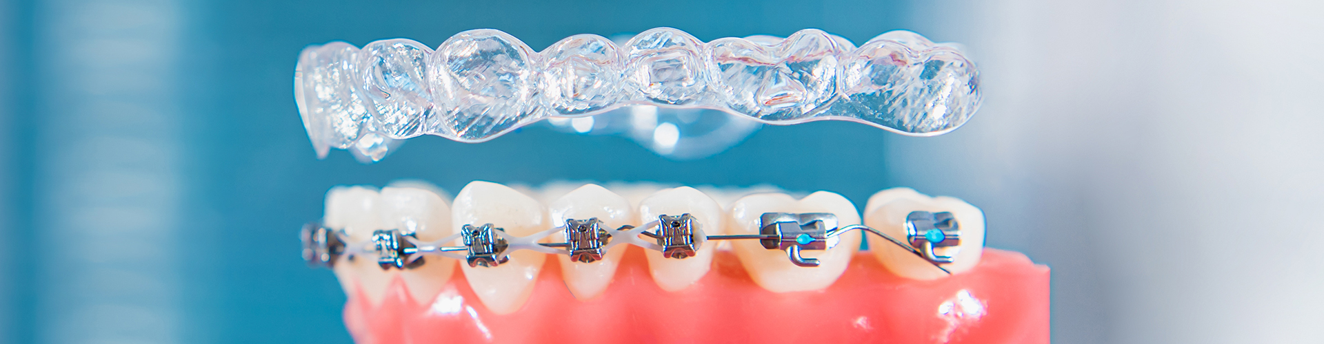 hand holding braces model with clear aligner above it